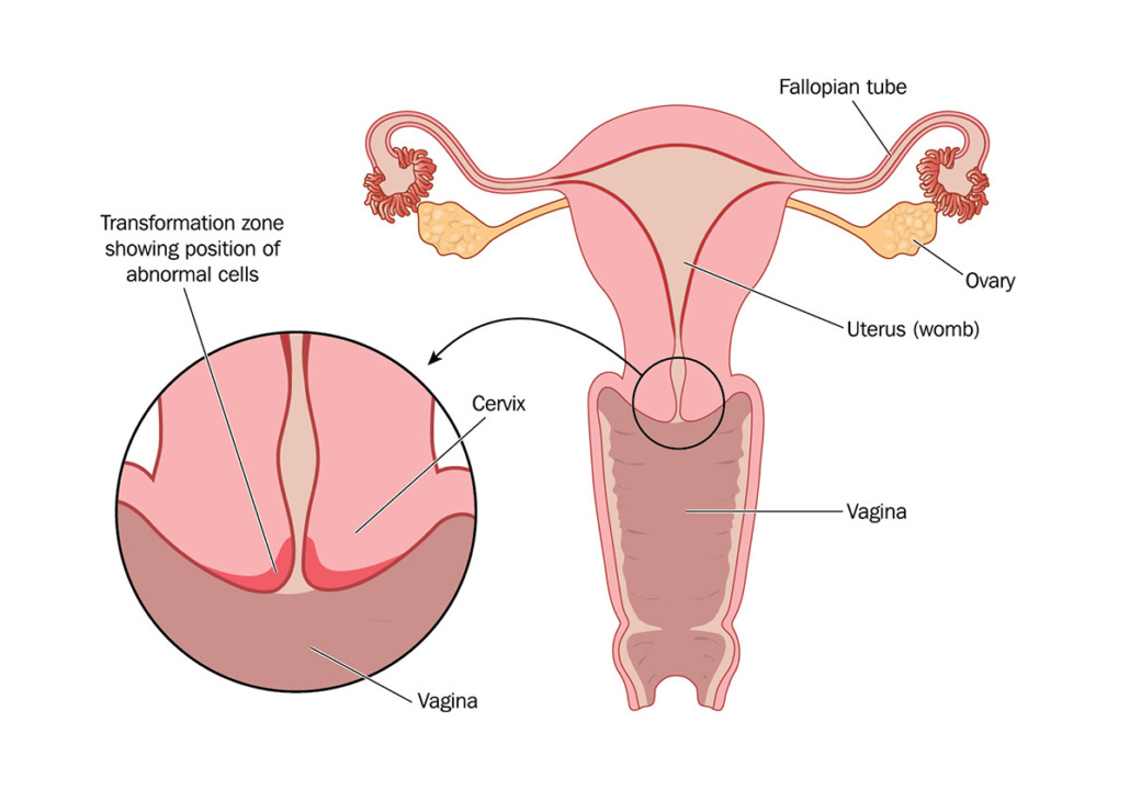 Cervical Cancer